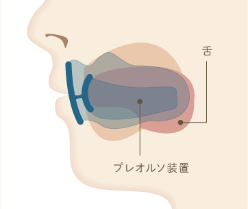 プレオルソイメージ