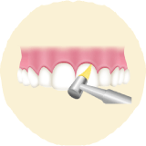 歯間や歯面をクリーニング